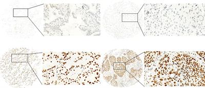 CDK7 is a prognostic biomarker for non-small cell lung cancer